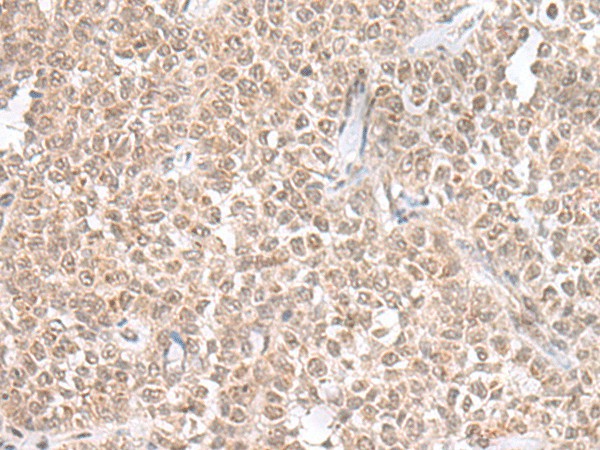 Immunohistochemistry of paraffin-embedded Human ovarian cancer tissue  using THAP12 Polyclonal Antibody at dilution of 1:45(?200)