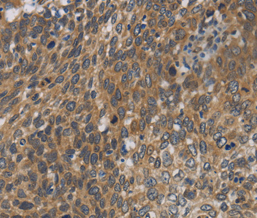 Immunohistochemistry of paraffin-embedded Human cervical cancer using Cytochrome b5 Polyclonal Antibody at dilution of 1:40