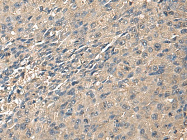 Immunohistochemistry of paraffin-embedded Human liver cancer tissue  using ZG16 Polyclonal Antibody at dilution of 1:95(?200)