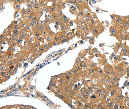 Immunohistochemistry of paraffin-embedded Human breast cancer tissue using SCN5A Polyclonal Antibody at dilution 1:30