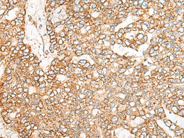 Immunohistochemistry of paraffin-embedded Human liver cancer tissue  using NME4 Polyclonal Antibody at dilution of 1:45(?200)