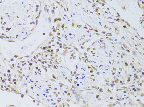 Immunohistochemistry of paraffin-embedded Human gastric cancer using FKBP4 Polyclonal Antibody at dilution of  1:100 (40x lens).