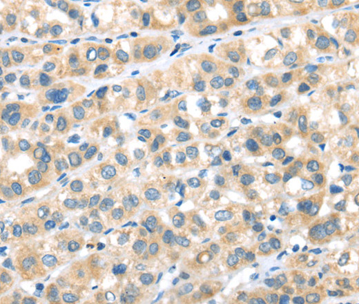 Immunohistochemistry of paraffin-embedded Human esophagus cancer tissue using RIPK4 Polyclonal Antibody at dilution 1:40