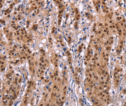 Immunohistochemistry of paraffin-embedded Human gastric cancer tissue using Ephrin A5 Polyclonal Antibody at dilution 1:40