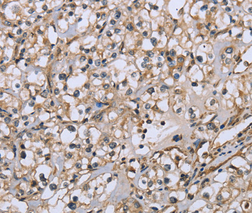 Immunohistochemistry of paraffin-embedded Human prostate cancer tissue using DTNB Polyclonal Antibody at dilution 1:50