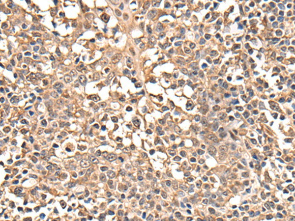 Immunohistochemistry of paraffin-embedded Human tonsil tissue  using ATRIP Polyclonal Antibody at dilution of 1:40(?200)