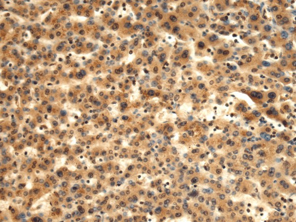 Immunohistochemistry of paraffin-embedded Human liver cancer tissue  using TMOD1 Polyclonal Antibody at dilution of 1:60(?200)