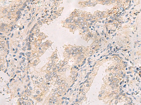 Immunohistochemistry of paraffin-embedded Human prost at e cancer tissue  using TNNT1 Polyclonal Antibody at dilution of 1:35(?200)