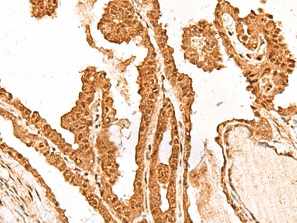 Immunohistochemistry of paraffin-embedded Human thyroid cancer tissue  using FAM111B Polyclonal Antibody at dilution of 1:50(?200)