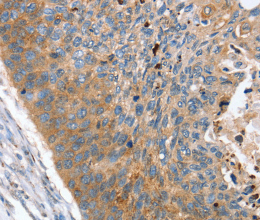 Immunohistochemistry of paraffin-embedded Human esophagus cancer using REG3A Polyclonal Antibody at dilution of 1:40