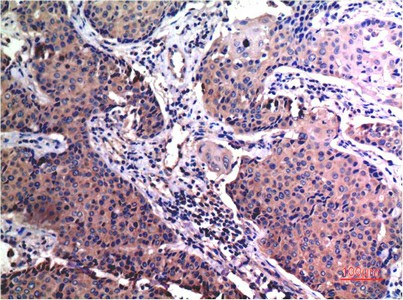 Immunohistochemistry of paraffin-embedded Human breast carcinoma tissue using MMP2 Monoclonal Antibody at dilution of 1:200.