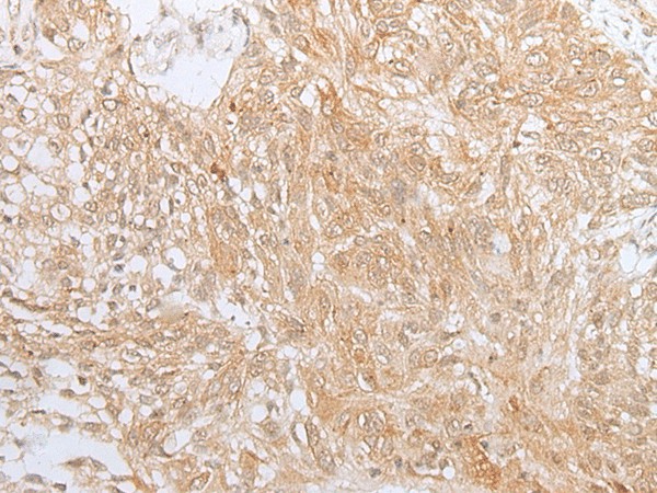 Immunohistochemistry of paraffin-embedded Human lung cancer tissue  using ZNF34 Polyclonal Antibody at dilution of 1:40(?200)