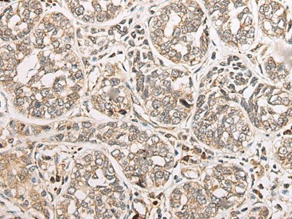 Immunohistochemistry of paraffin-embedded Human esophagus cancer tissue  using COA7 Polyclonal Antibody at dilution of 1:55(?200)