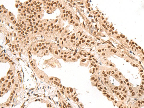 Immunohistochemistry of paraffin-embedded Human thyroid cancer tissue  using LGALS4 Polyclonal Antibody at dilution of 1:35(?200)