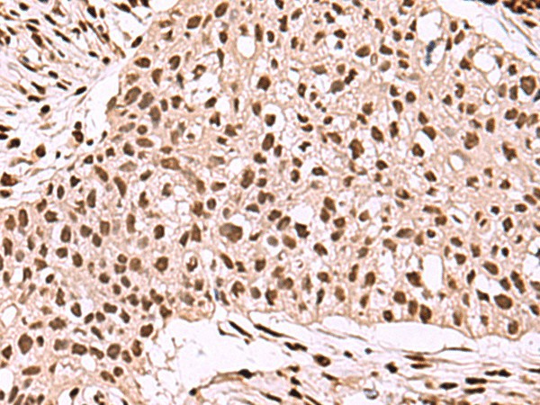 Immunohistochemistry of paraffin-embedded Human esophagus cancer tissue  using SMAD7 Polyclonal Antibody at dilution of 1:40(?200)