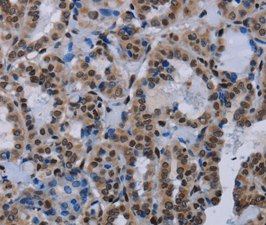 Immunohistochemistry of paraffin-embedded Human thyroid cancer using HMGB1 Polyclonal Antibody at dilution of 1:30