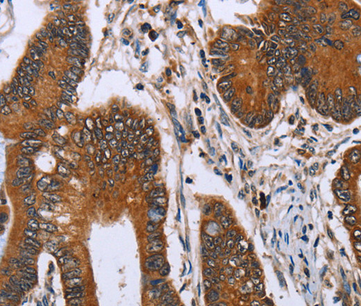 Immunohistochemistry of paraffin-embedded Human colon cancer tissue using IHH Polyclonal Antibody at dilution 1:30