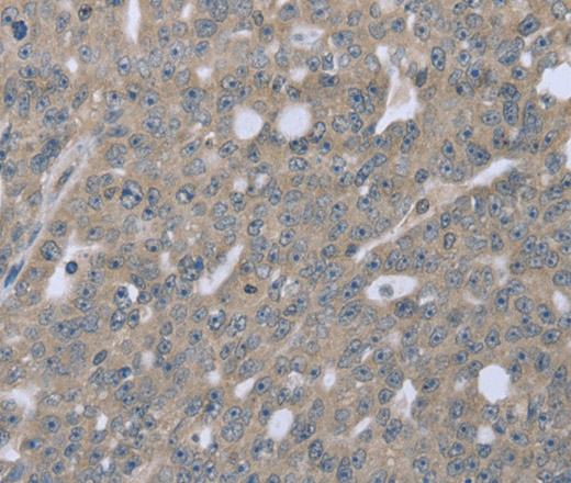 Immunohistochemistry of paraffin-embedded Human ovarian cancer tissue using BMX Polyclonal Antibody at dilution 1:30