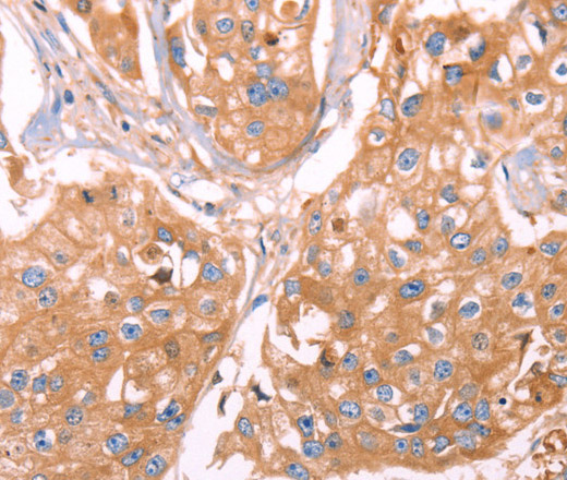 Immunohistochemistry of paraffin-embedded Human breast cancer using GC Polyclonal Antibody at dilution of 1:40