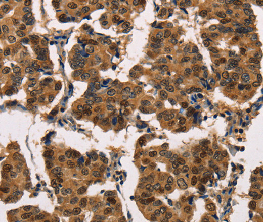 Immunohistochemistry of paraffin-embedded Human breast cancer tissue using ATP7A  Polyclonal Antibody at dilution 1:50