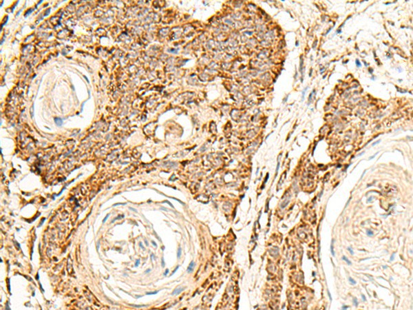 Immunohistochemistry of paraffin-embedded Human esophagus cancer tissue  using ATP5I Polyclonal Antibody at dilution of 1:30(?200)