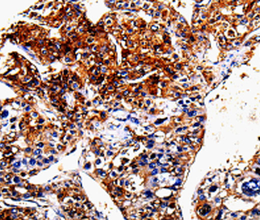 Immunohistochemistry of paraffin-embedded Human liver cancer tissue using ANXA7 Polyclonal Antibody at dilution 1:150