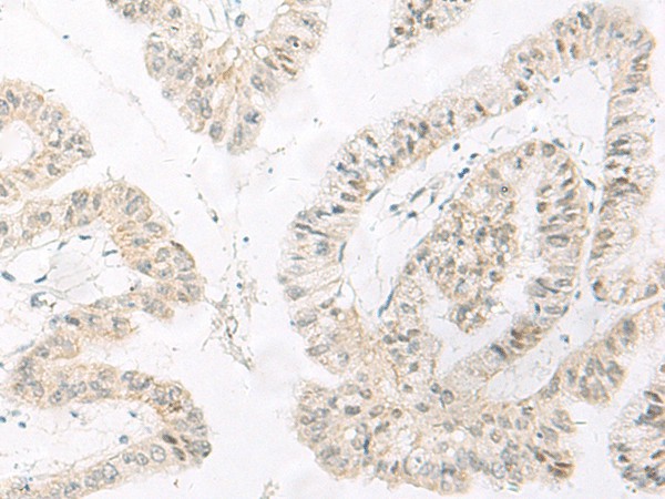 Immunohistochemistry of paraffin-embedded Human liver cancer tissue  using HABP4 Polyclonal Antibody at dilution of 1:60(?200)