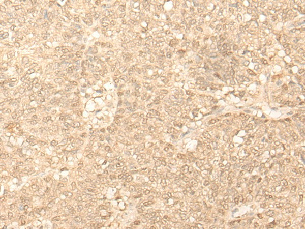 Immunohistochemistry of paraffin-embedded Human ovarian cancer tissue  using FAH Polyclonal Antibody at dilution of 1:40(?200)