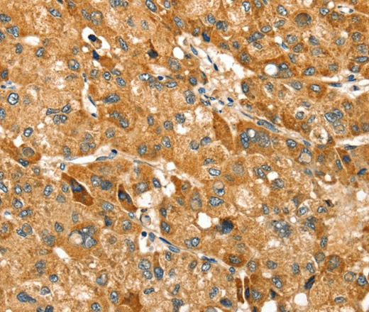 Immunohistochemistry of paraffin-embedded Human liver cancer using TRIM62 Polyclonal Antibody at dilution of 1:30