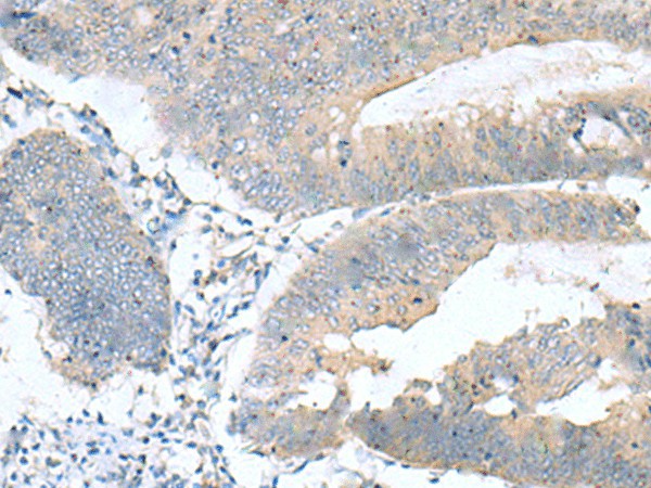 Immunohistochemistry of paraffin-embedded Human colorectal cancer tissue  using KRCC1 Polyclonal Antibody at dilution of 1:60(?200)