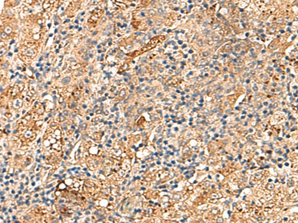 Immunohistochemistry of paraffin-embedded Human liver cancer tissue  using DNAJC14 Polyclonal Antibody at dilution of 1:70(?200)