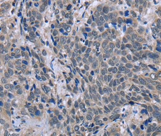 Immunohistochemistry of paraffin-embedded Human cervical cancer tissue using BMX Polyclonal Antibody at dilution 1:30