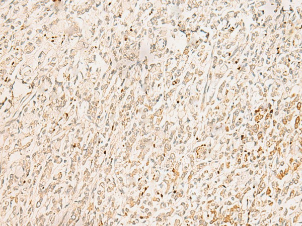 Immunohistochemistry of paraffin-embedded Human gastric cancer tissue  using GINS2 Polyclonal Antibody at dilution of 1:50(?200)