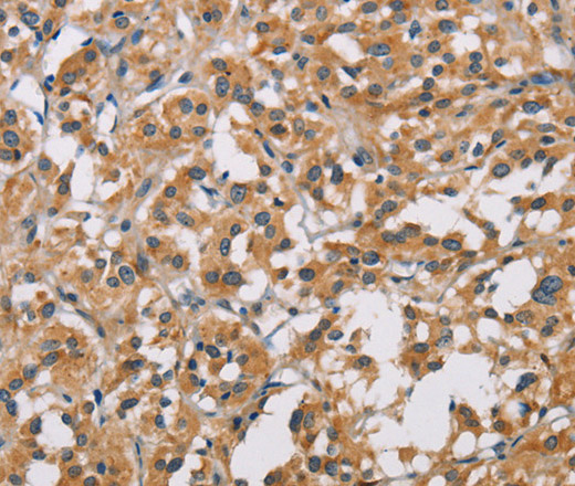 Immunohistochemistry of paraffin-embedded Human thyroid cancer tissue using PDCD1LG2 Polyclonal Antibody at dilution 1:50