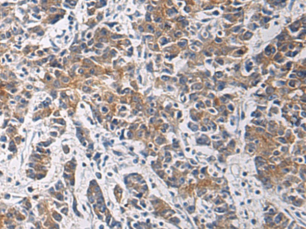 Immunohistochemistry of paraffin-embedded Human colorectal cancer tissue  using TMOD3 Polyclonal Antibody at dilution of 1:60(?200)