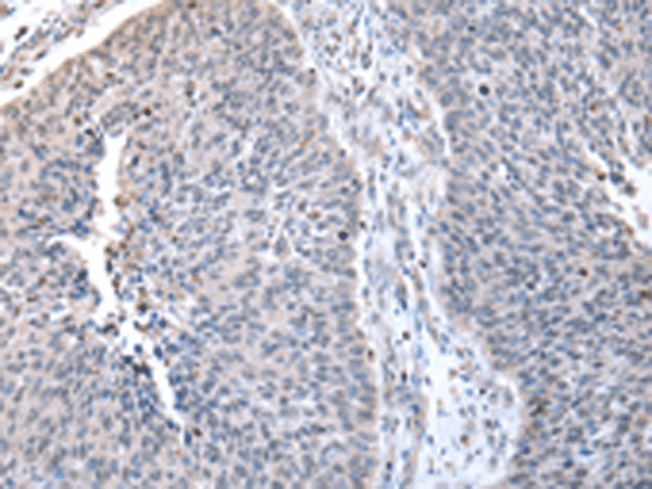 Immunohistochemistry of paraffin-embedded Human lung cancer tissue  using ZNF23 Polyclonal Antibody at dilution of 1:50(?200)