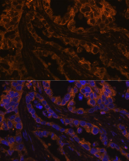 Immunofluorescence analysis of human lung cancer cells using Cytokeratin 7 (Cytokeratin 7 (KRT7)) Polyclonal Antibody at dilution of 1:100. Blue: DAPI for nuclear staining.