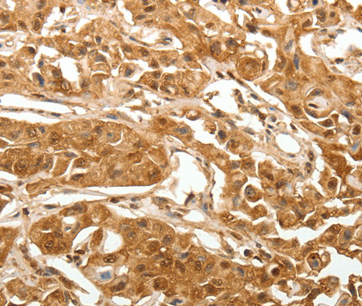 Immunohistochemistry of paraffin-embedded Human lung cancer using TXN Polyclonal Antibody at dilution of 1:40