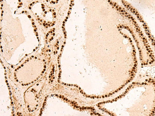 Immunohistochemistry of paraffin-embedded Human thyroid cancer tissue  using SNRPB2 Polyclonal Antibody at dilution of 1:75(?200)