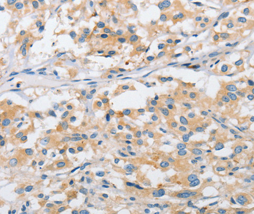 Immunohistochemistry of paraffin-embedded Human thyroid cancer tissue using ARHGEF9 Polyclonal Antibody at dilution 1:50