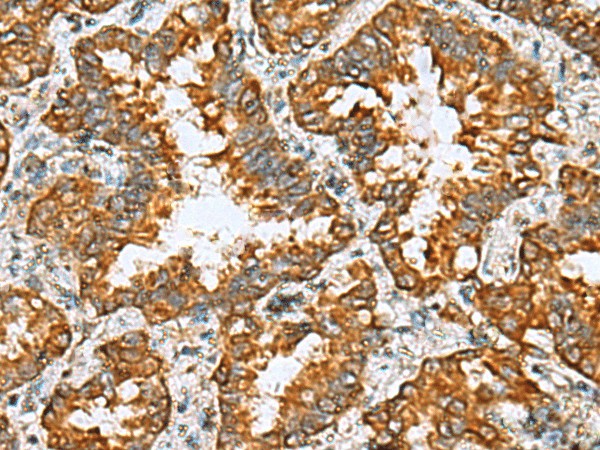 Immunohistochemistry of paraffin-embedded Human lung cancer tissue  using TMED10 Polyclonal Antibody at dilution of 1:65(?200)