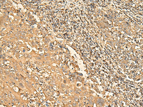 Immunohistochemistry of paraffin-embedded Human cervical cancer tissue  using RPS28 Polyclonal Antibody at dilution of 1:30(?200)