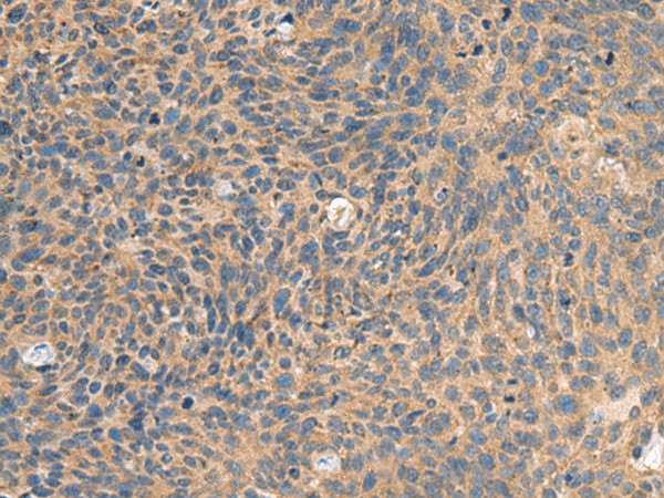 Immunohistochemistry of paraffin-embedded Human cervical cancer tissue  using EIF1AX Polyclonal Antibody at dilution of 1:65(?200)