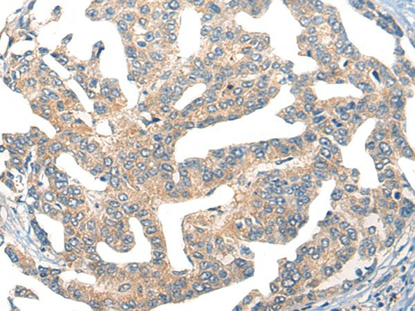 Immunohistochemistry of paraffin-embedded Human liver cancer tissue  using GPR55 Polyclonal Antibody at dilution of 1:55(?200)