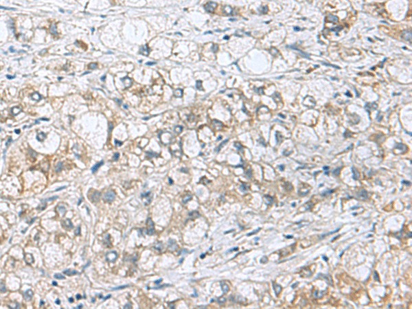 Immunohistochemistry of paraffin-embedded Human liver cancer tissue  using PHPT1 Polyclonal Antibody at dilution of 1:210(?200)