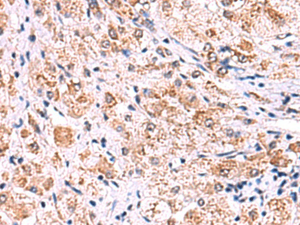 Immunohistochemistry of paraffin-embedded Human liver cancer tissue  using ECSIT Polyclonal Antibody at dilution of 1:75(?200)