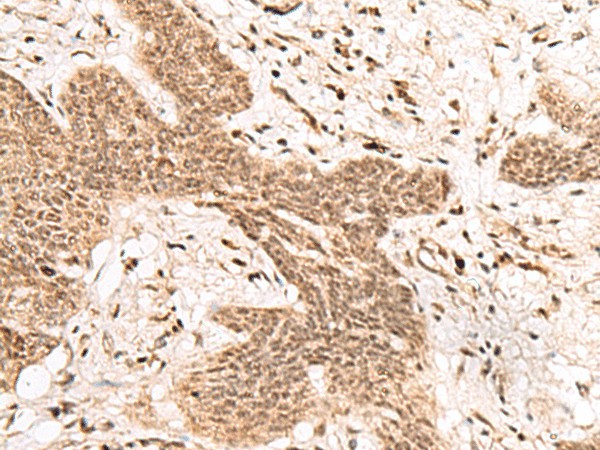 Immunohistochemistry of paraffin-embedded Human esophagus cancer tissue  using FAM111B Polyclonal Antibody at dilution of 1:50(?200)