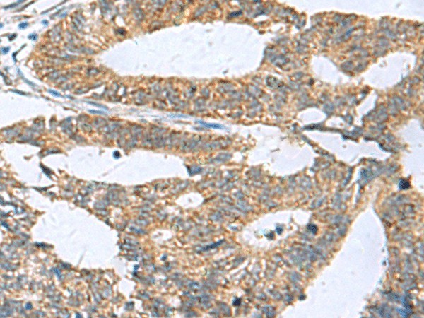 Immunohistochemistry of paraffin-embedded Human colorectal cancer tissue  using HPCAL1 Polyclonal Antibody at dilution of 1:70(?200)