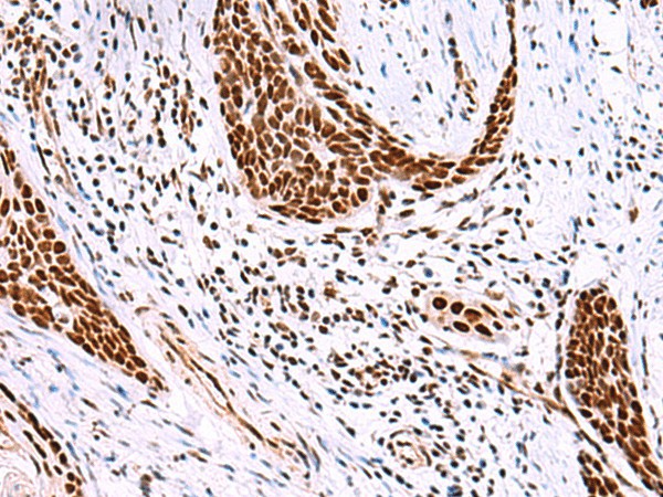 Immunohistochemistry of paraffin-embedded Human esophagus cancer tissue  using ISY1-RAB43 Polyclonal Antibody at dilution of 1:30(?200)