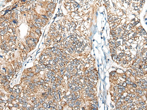 Immunohistochemistry of paraffin-embedded Human gastric cancer tissue  using NADK2 Polyclonal Antibody at dilution of 1:40(?200)